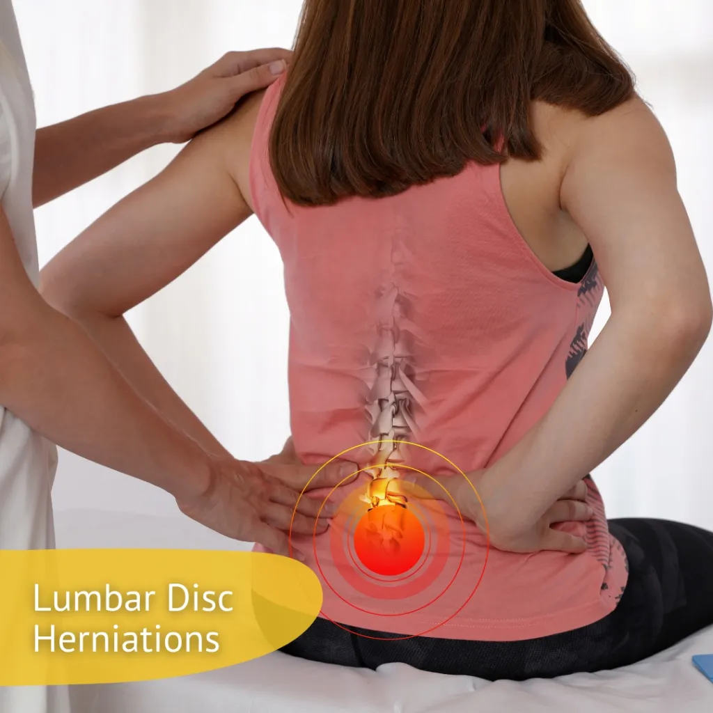 Lumbar Disc Herniations